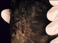 Scar